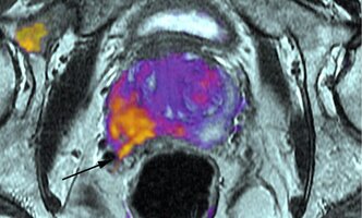 prostat-kanser-780x470.jpg prostat-kanser-780x470.jpg